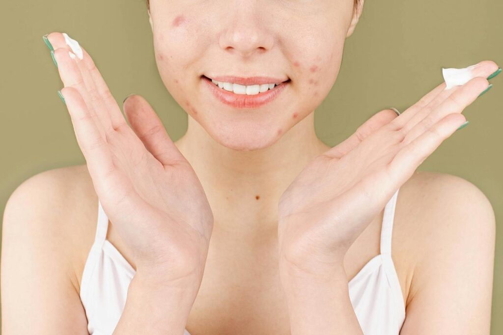 Close-up of a person’s face with visible acne on the chin and jawline.